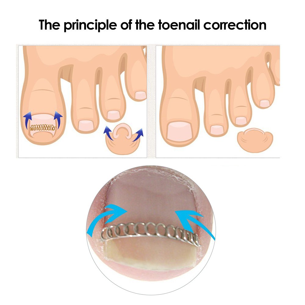 Sozzumi Ingrown Fingernail Correction Wire Nail Corrector Pedicure Foot Care Tool Toenail Correction Tool